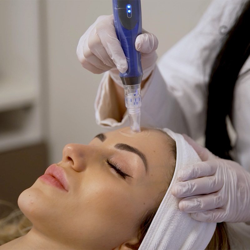 Clinician performing SkinPen microneedling treatment