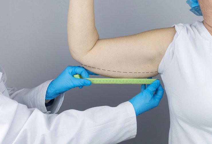 Clinician measuring upper arm before arm lift surgery