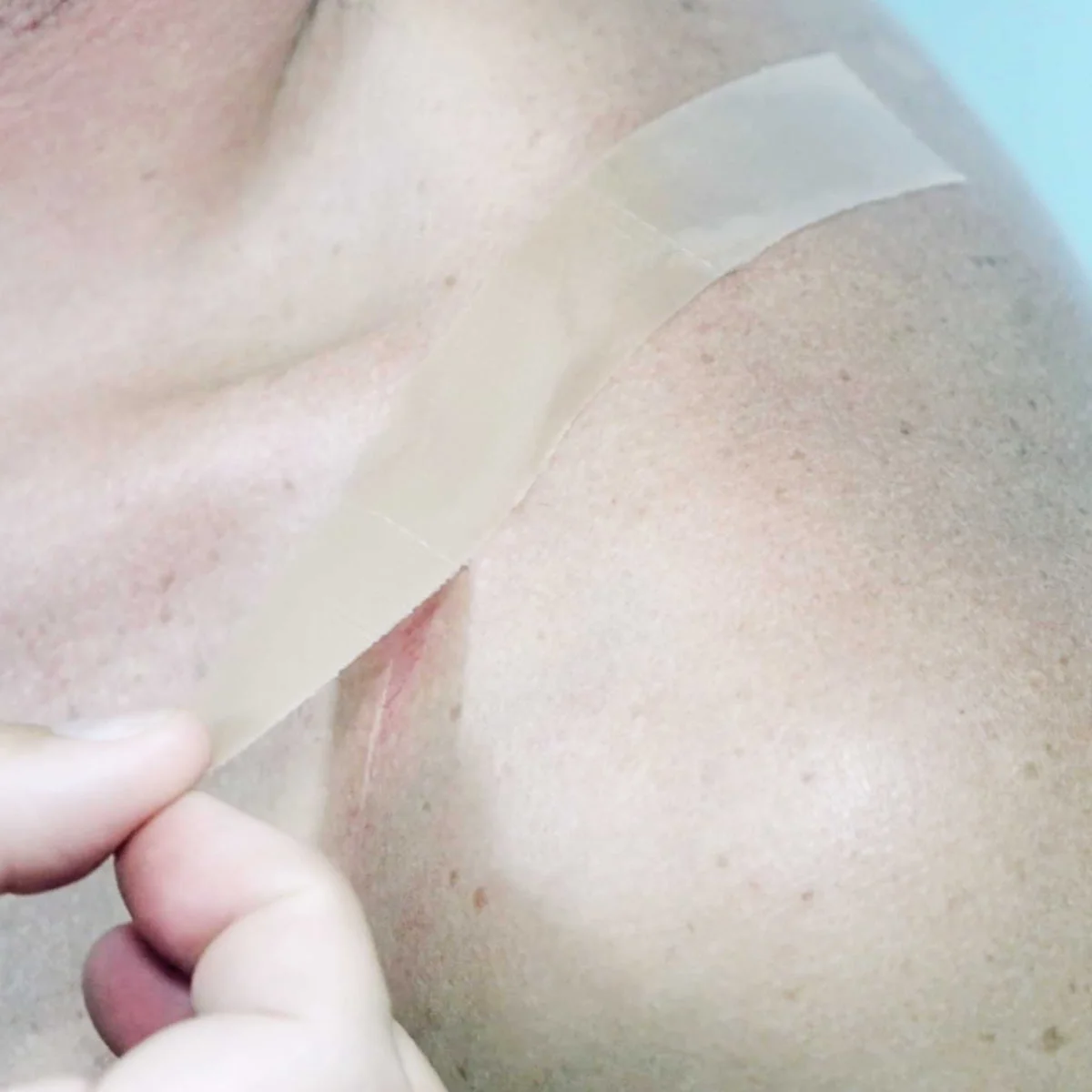 Nokori Small Incision Kit