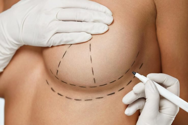 Breast lift (mastopexy) surgery at Evolve Plastic Surgery