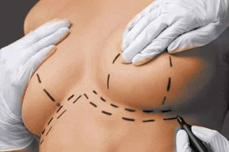 Breast Reduction Surgery