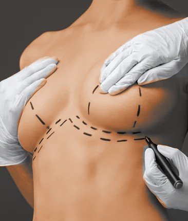 Breast Reduction