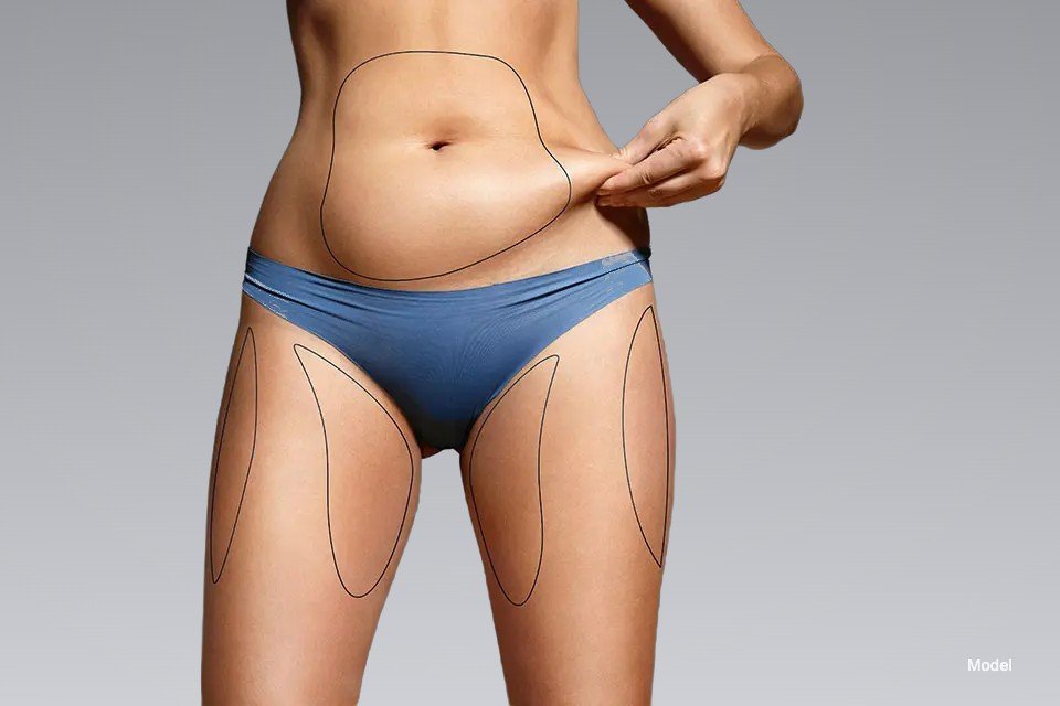 Liposuction